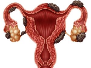 Endometrial tumors 