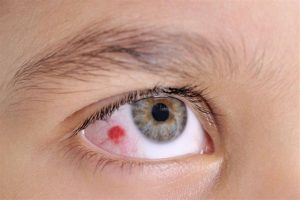 Blood spots in the eyes