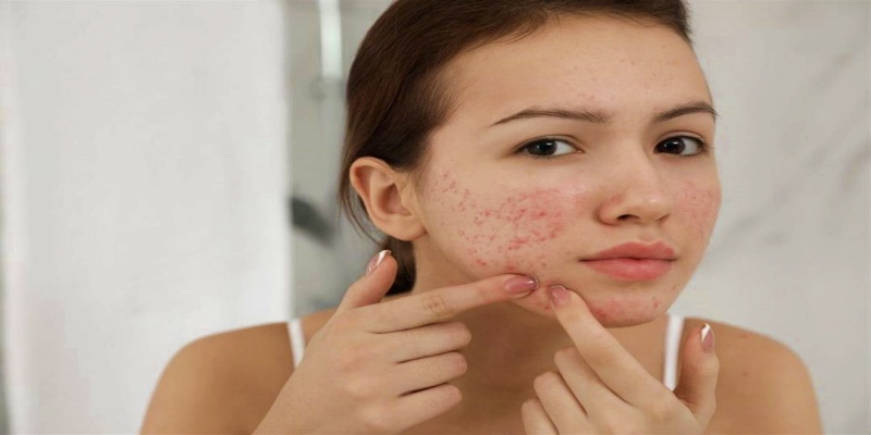 Acne and skin infections