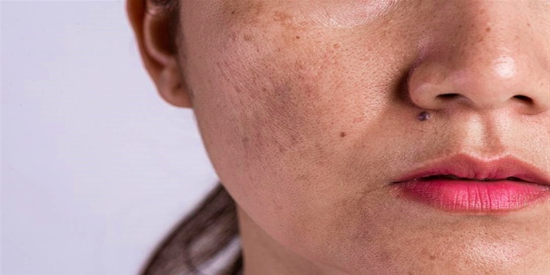 The appearance of skin pigmentation