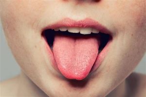 Swelling of the tongue