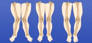 Causes of foot deformities in children