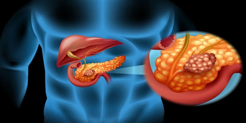 Pancreas cancer