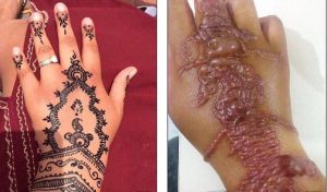 Common harms of black henna