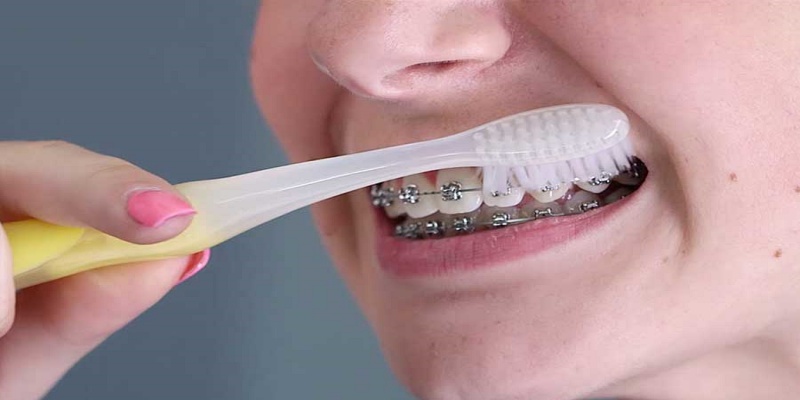 Orthodontics and oral hygiene