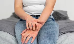   What is psoriasis?
