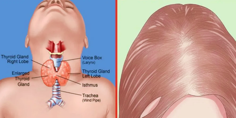 Thyroid disease and hair loss